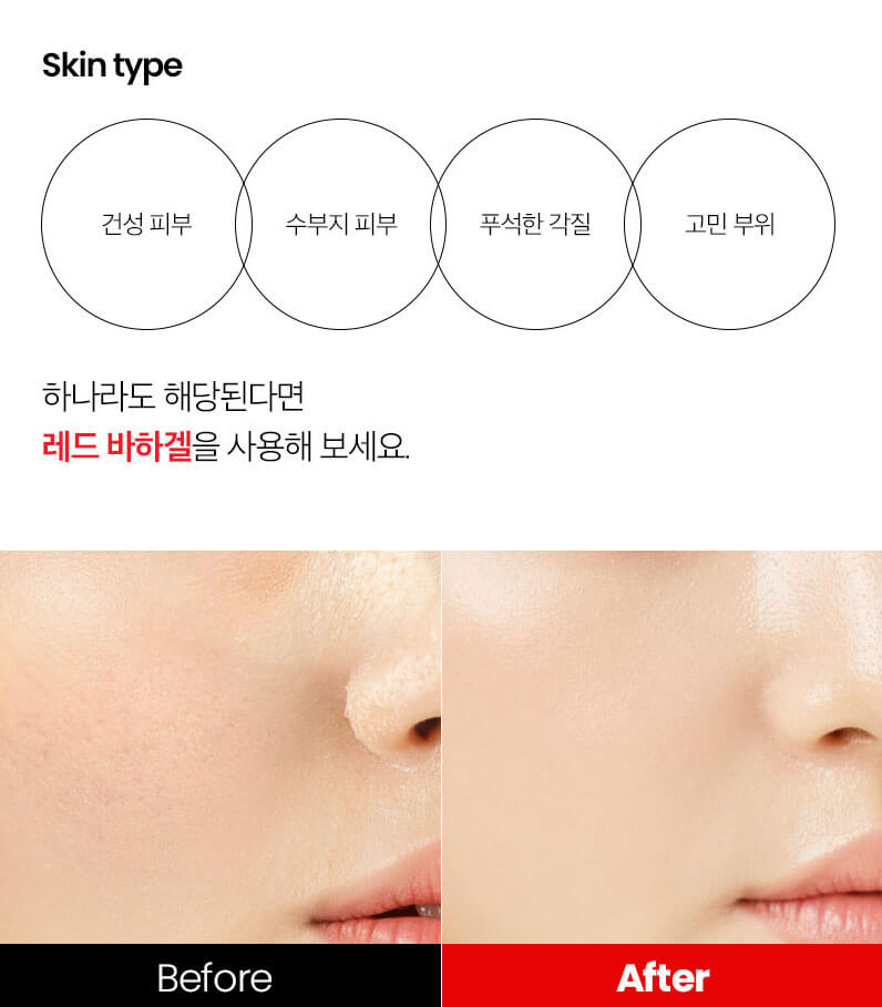 닥터윈트 레드 바하겔 &#44;마스크 벗은 후 내 피부는