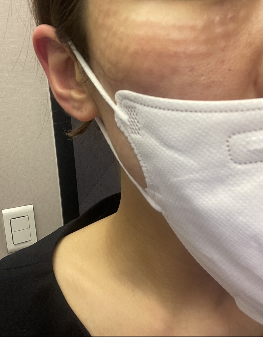 코조각주사 콧볼축소 효과 20