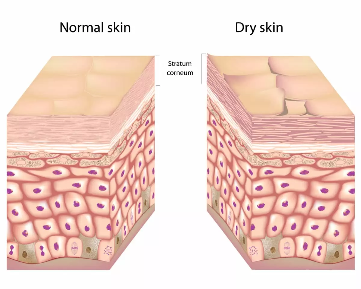 Dead skin