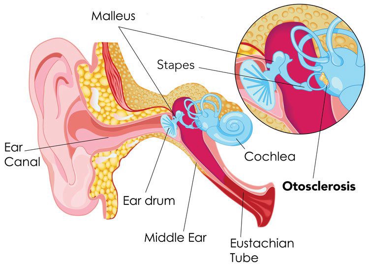  이경화증(Otosclerosis) 이란 무엇인가요?
