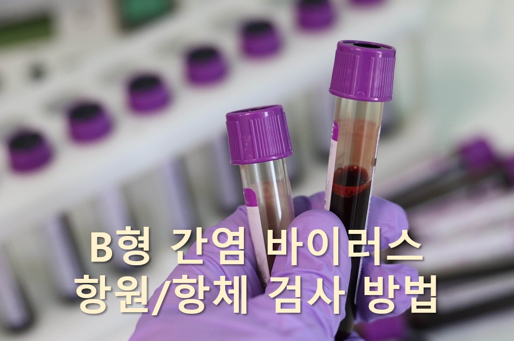  B형 간염 바이러스 항원/항체 검사 방법