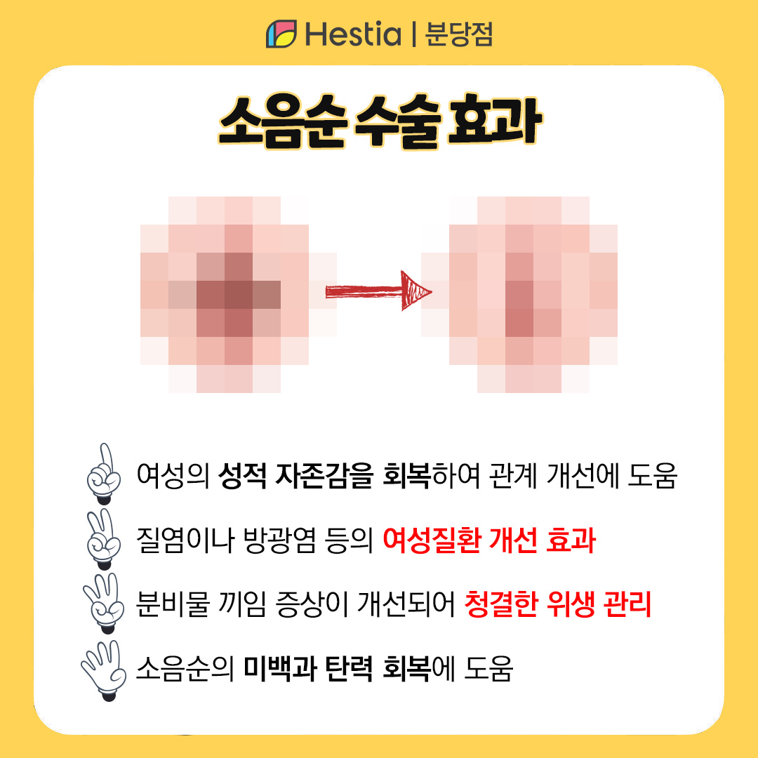 소음순미백 소음순 착색 생식기 가려움증 소음순 수술 효과