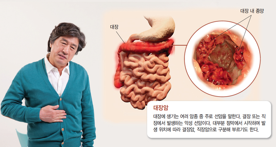  대장암, 원인과 예방법을 알아보자