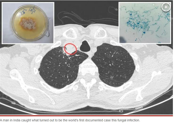 한 남성, 세계 최초 곰팡이에 의한 '식물성 진균병' 감염 사례 Man infected with deadly plant fungus in world-first case