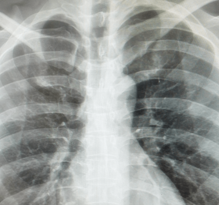 갈비뼈 x ray 사진