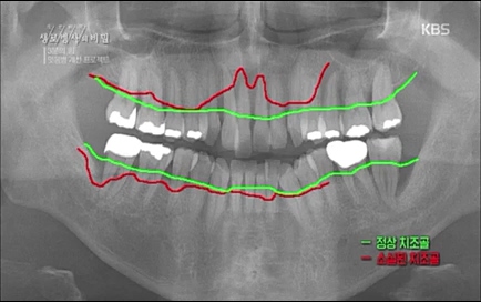 [670회] 생로병사의 비밀 - KBS670회] 생로병사의 비밀.ts_20220505_143153.715.jpg