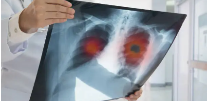  [건강정보]만성폐쇄성 폐질환 (COPD): 원인 및 치료