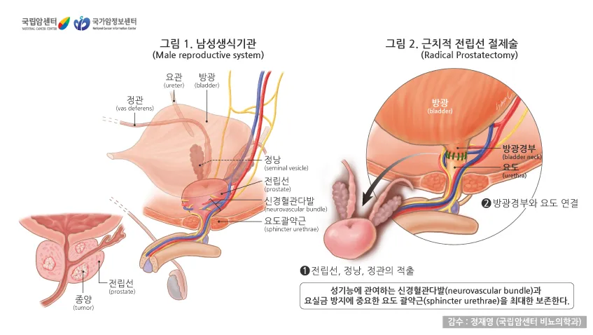 전립선비대증 증상