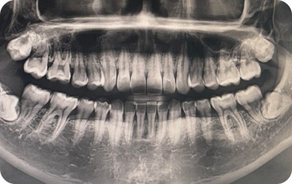 나의 치아&#44; 잇몸 엑스레이... 치료가 필요하다