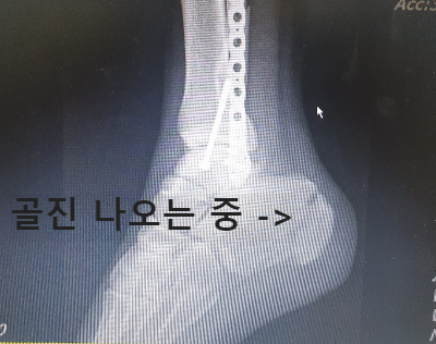  종골 골절 완치 기간, 재활 치료, 후유증 알고 싶으신가요?