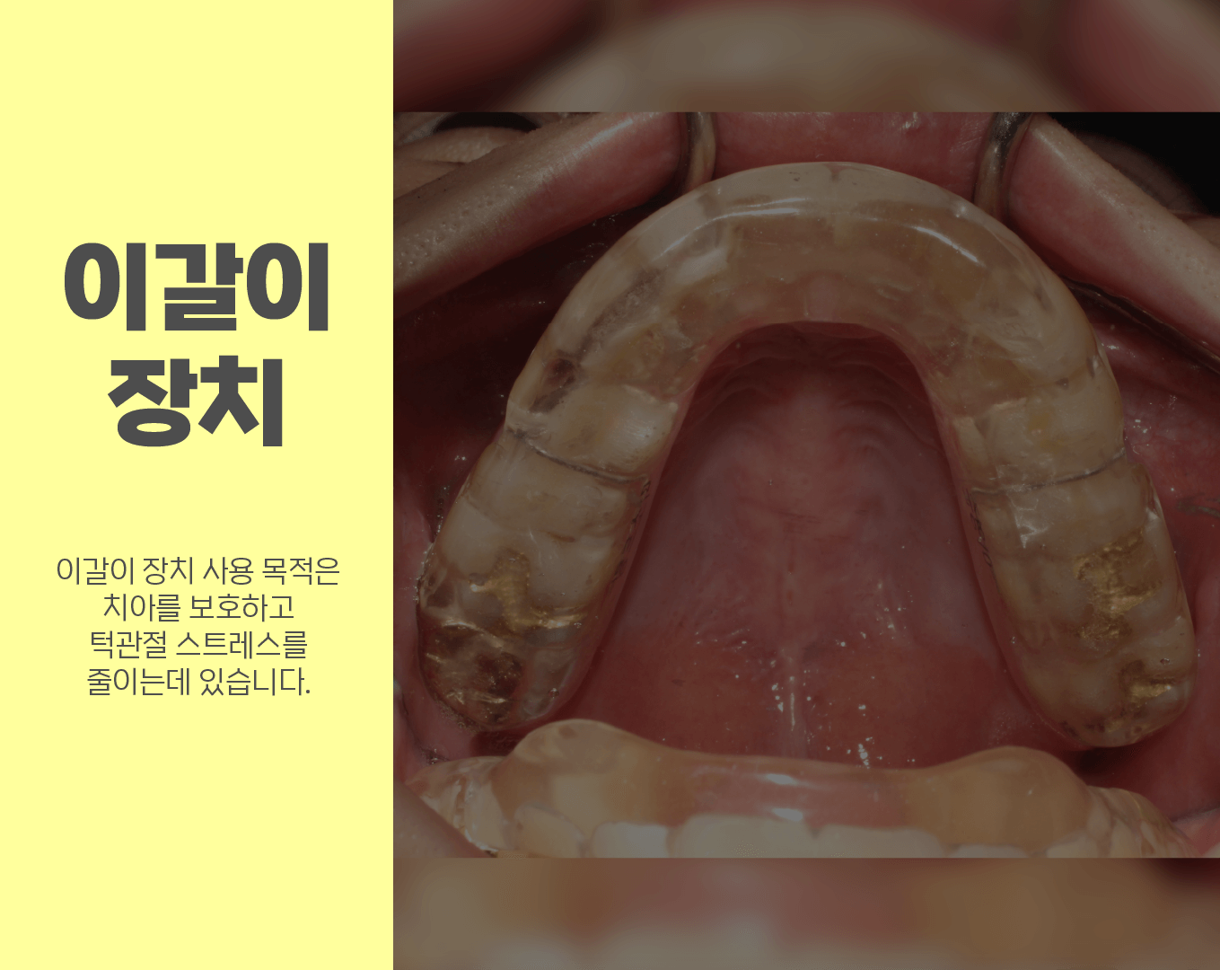 이갈이-장치-사용-목적