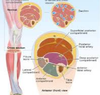 종아리-근육-통증-구획증후군