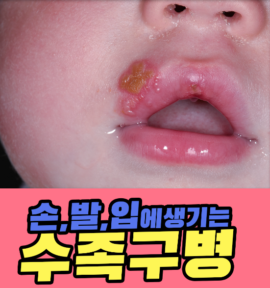  아기 수족구의 증상과 후유증
