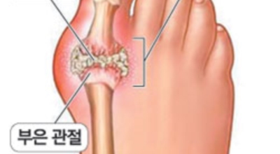 통풍이미지