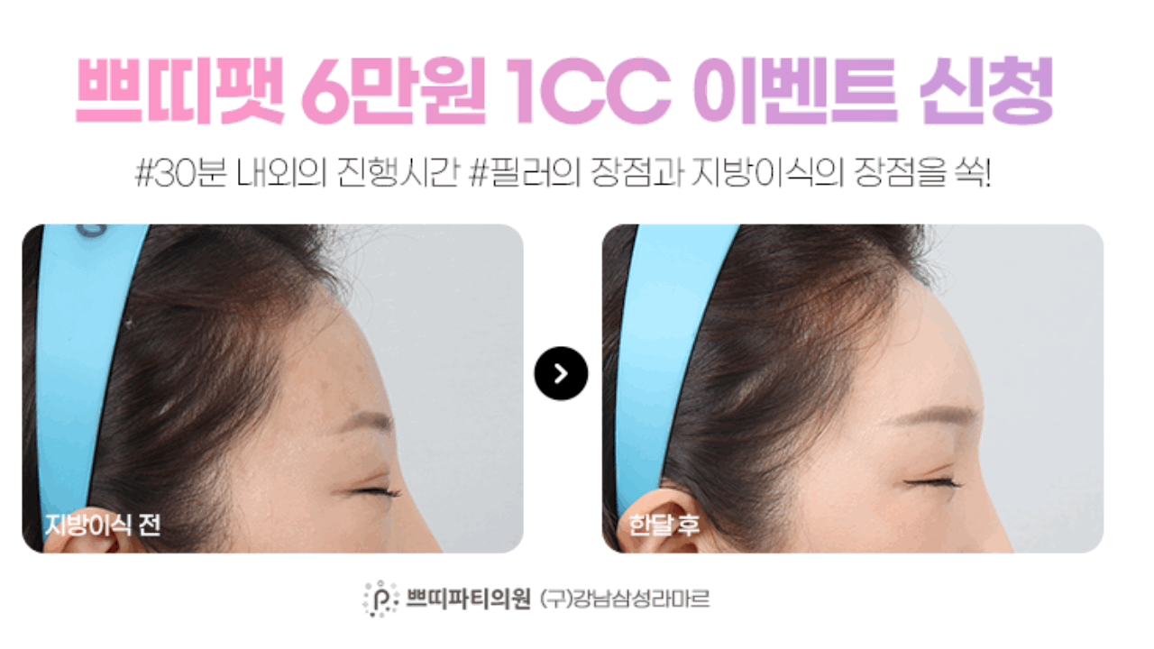 미세지방이식 얼굴지방이식가격 쁘띠팻은 어때요?