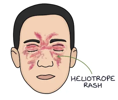 heliotrope rash
