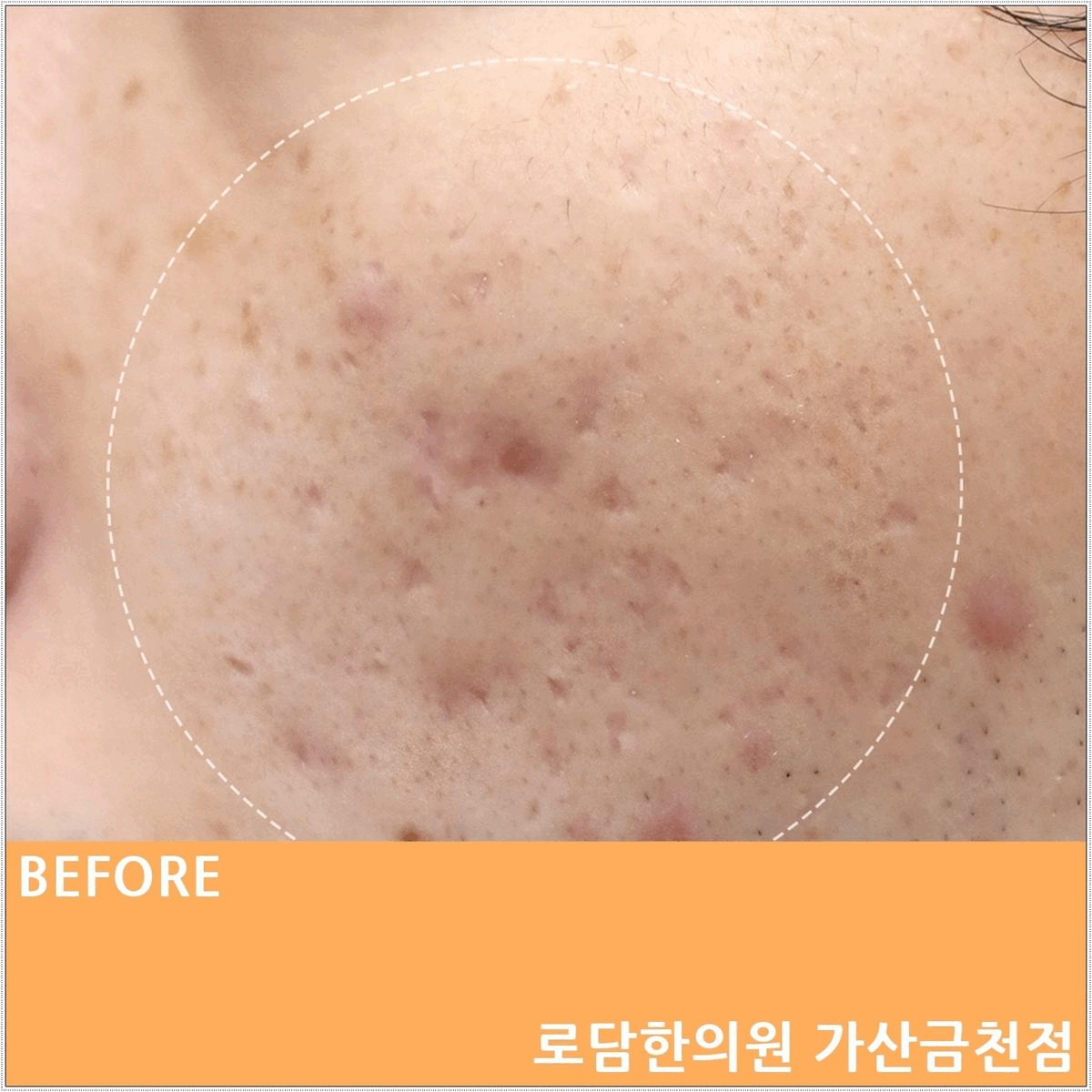  영등포 여드름 흉터 로담한의원의 새살침 패인 자국 제거 과정