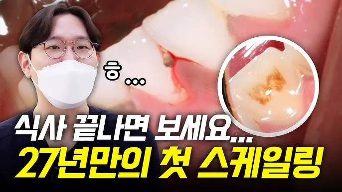 스케일링 후 양치 통증 음식_6
