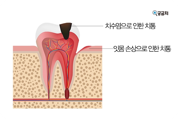 치통치료약추천3