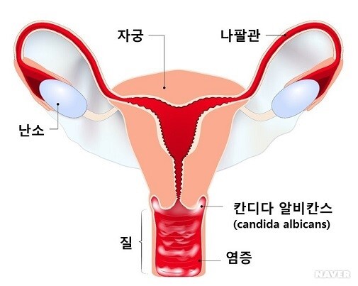  산부인과 질환