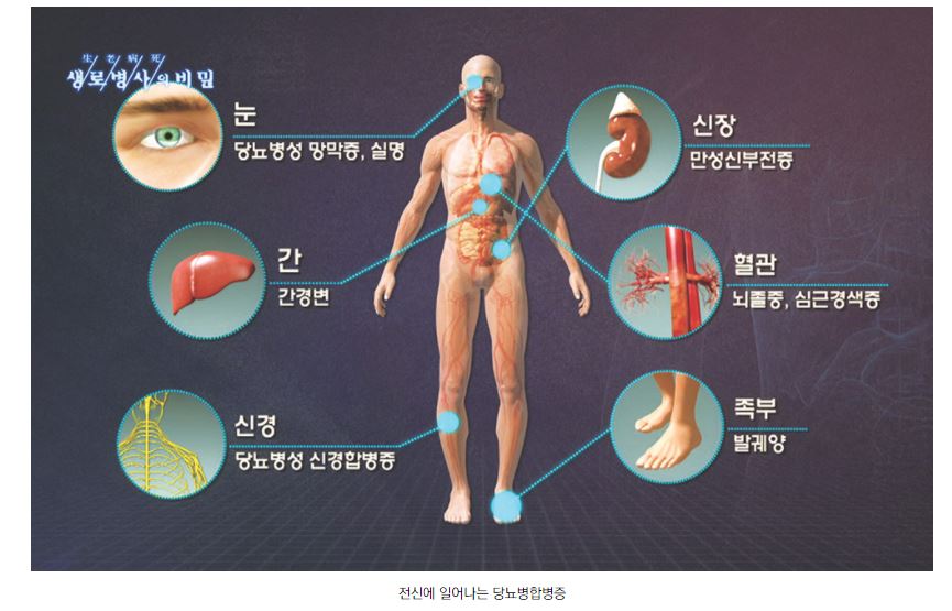 [당뇨!!]  바보야 핵심은 혈당이 아니야~