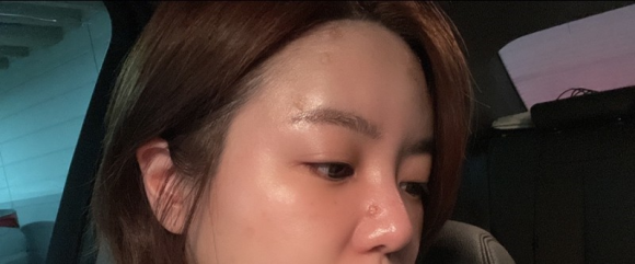 이마필러잘하는곳 후기! 6