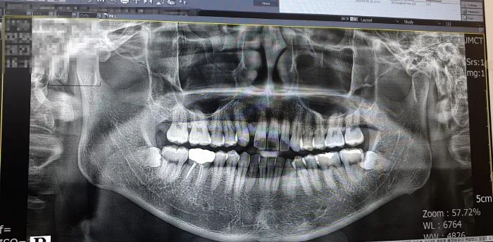 치아 엑스레이 사진