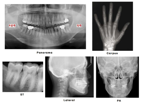 치과 엑스레이 사진
