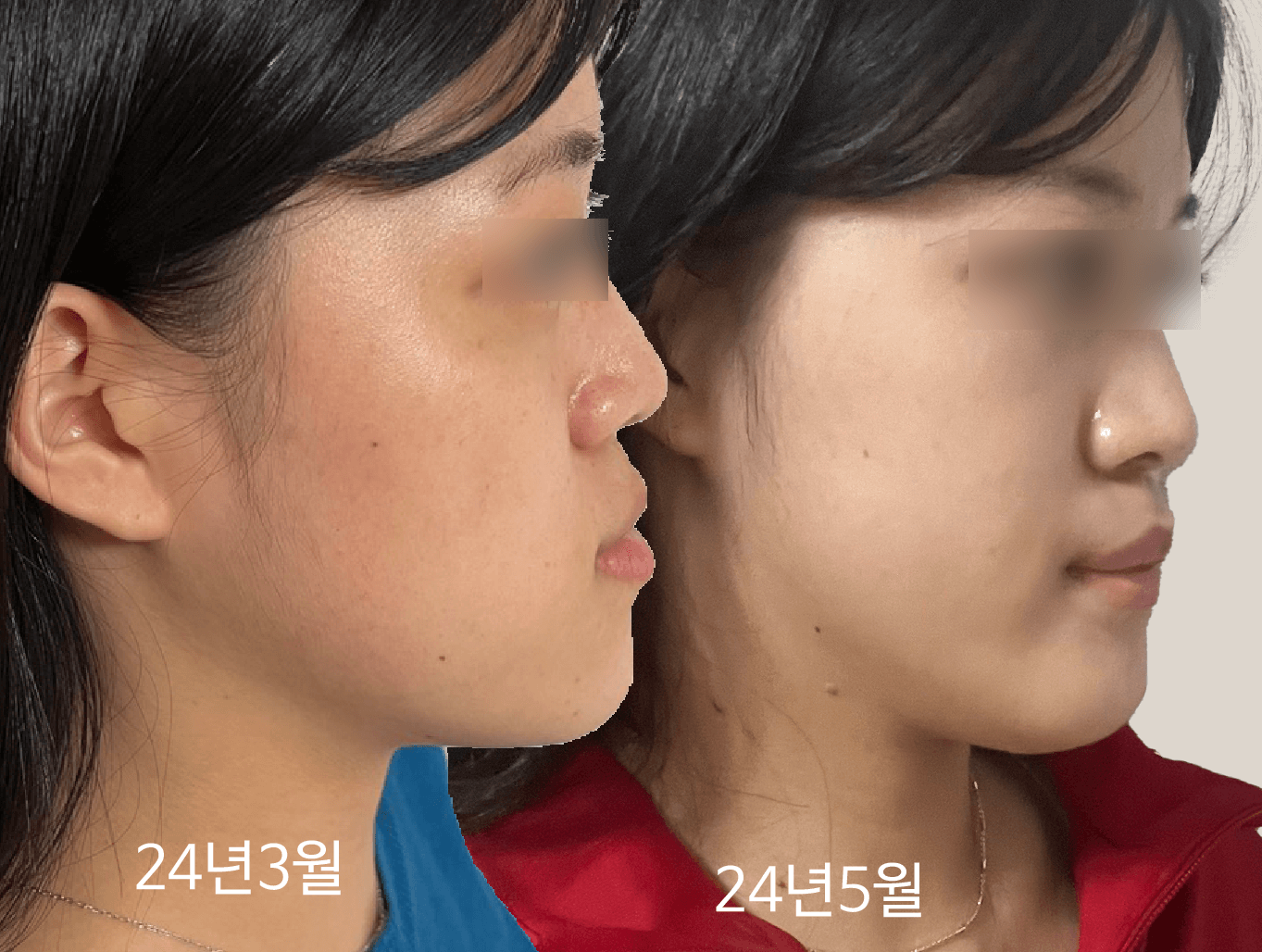 비수술-주걱턱-교정-2달간의변화