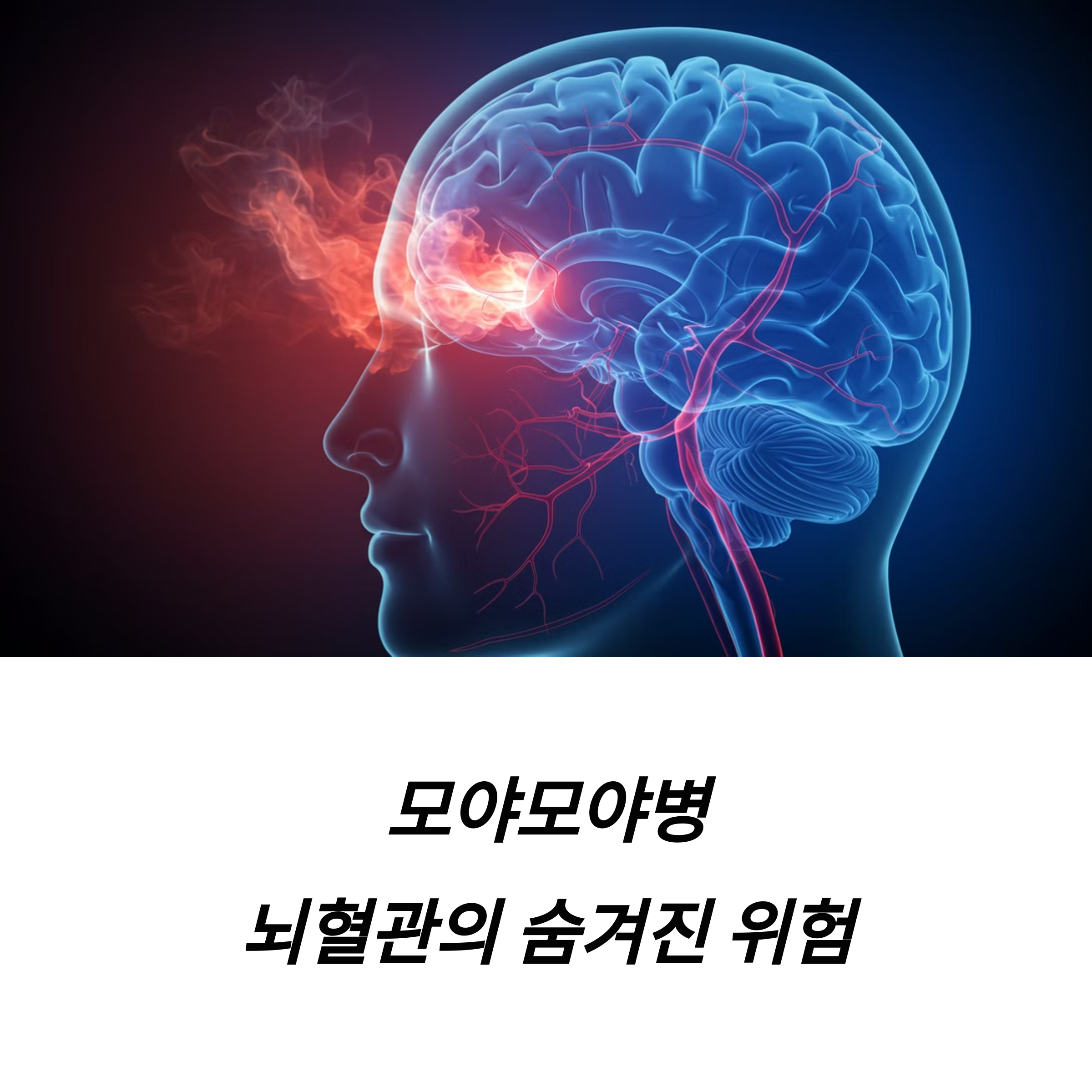 모야모야병 증상 치료법 위험 신호 발병 원인 관리법