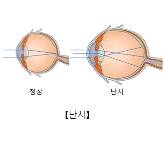 난시의-종류와-특징