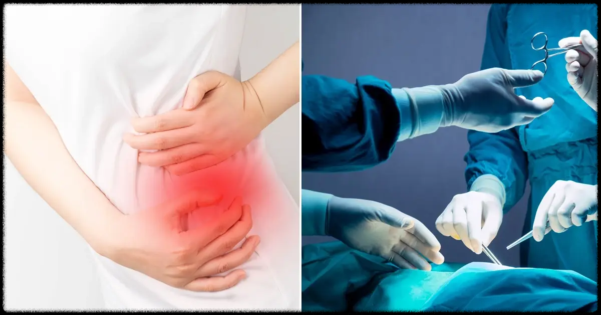  출산 고통과 똑같다는 요로결석 환자 몸에서 나온 돌 이렇게 생겼다