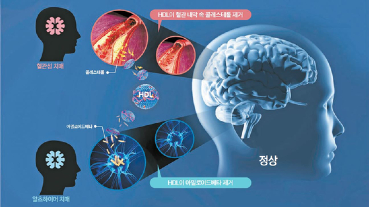 치매 초기 증상 8가지 단계별 특징 치매 예방 두뇌운동 치료 방법