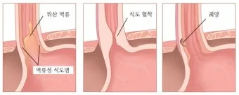 역류성 식도염 좋은음식, 피해야하는 음식_42