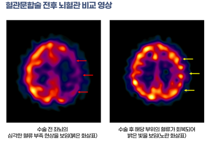 - 혈관문합술 전후 뇌혈관 비교