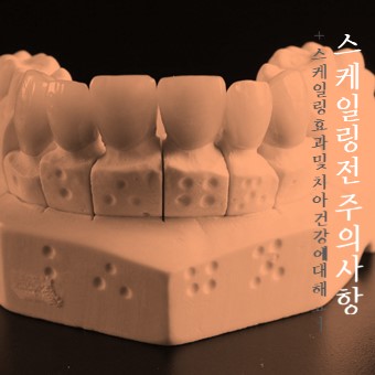  스케일링 전 알아두어야 할 꿀팁