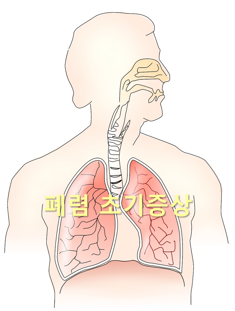  폐렴 초기증상과 폐렴 치료 기간
