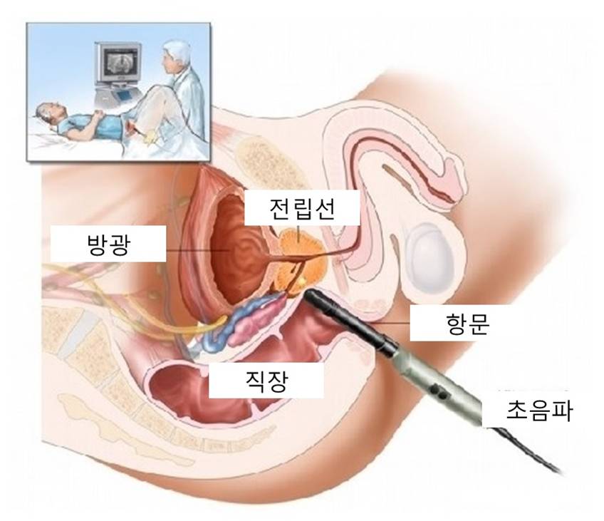  전립선 석회화 의미와 치료법은요?
