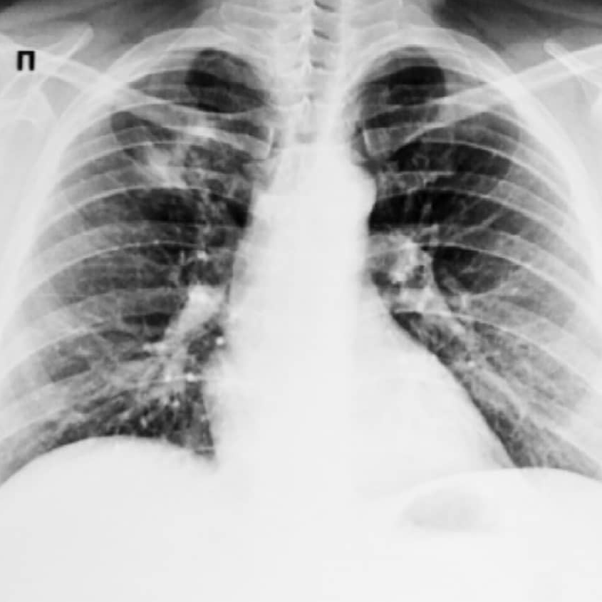 엑스레이로 찍은 폐 사진