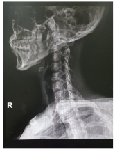 경추 디스크 증상