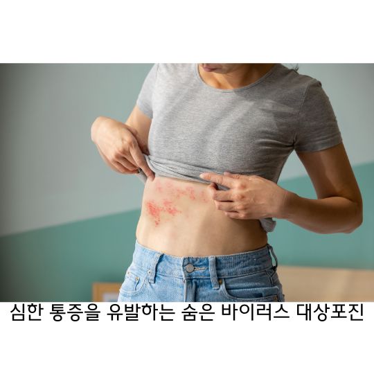 대상포진 면역력이 약해지면 심한 통증을 유발하는 수두 바이러스