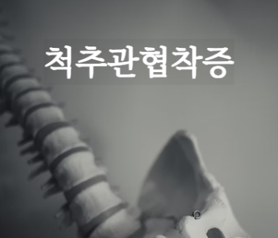 척추관협착증 원인&#44; 증상&#44; 치료 방법