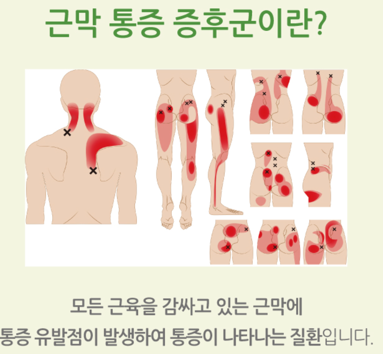 근막통증증후군