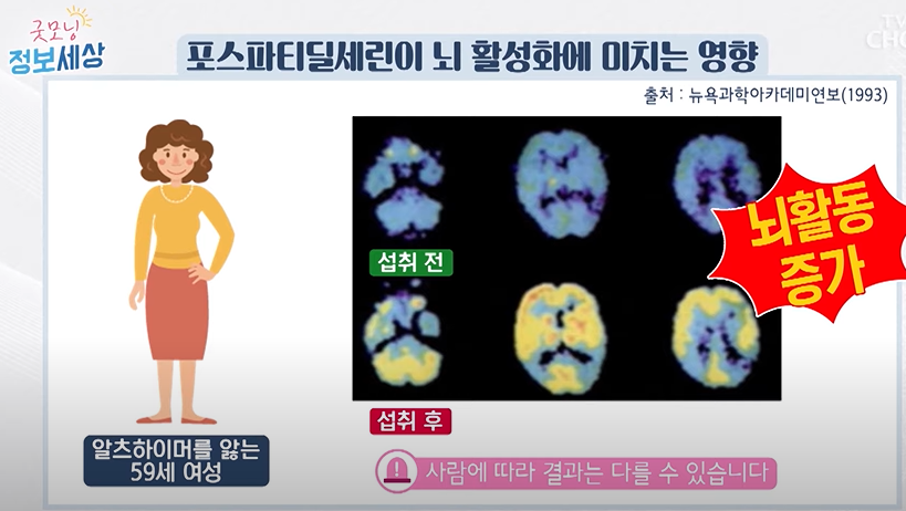 포스파티딜세린의 두뇌에 미치는 긍정적 효과와 부작용