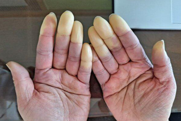 손이나 발가락의 손가락(1개만의 때도 있으면, 몇개의 때도 있다)의, 어느 부분으로부터 앞이 갑자기 하얗게 된다