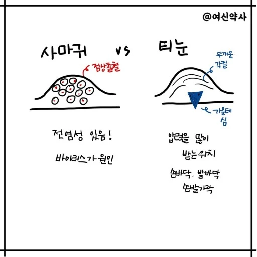 사마귀 vs 티눈 차이