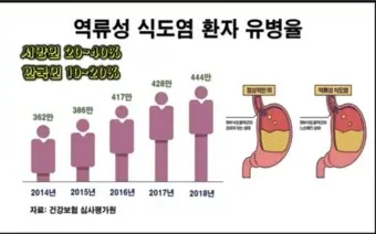 역류성 식도염 원인 초기증상 예방하는 방법_19