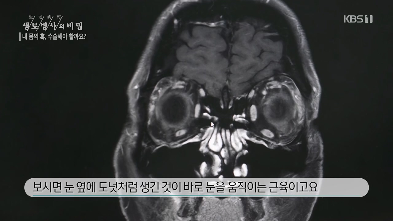 생로병사의 비밀.E870.230532p.H264-F1RST.mp4_20230605_201520.137.jpg