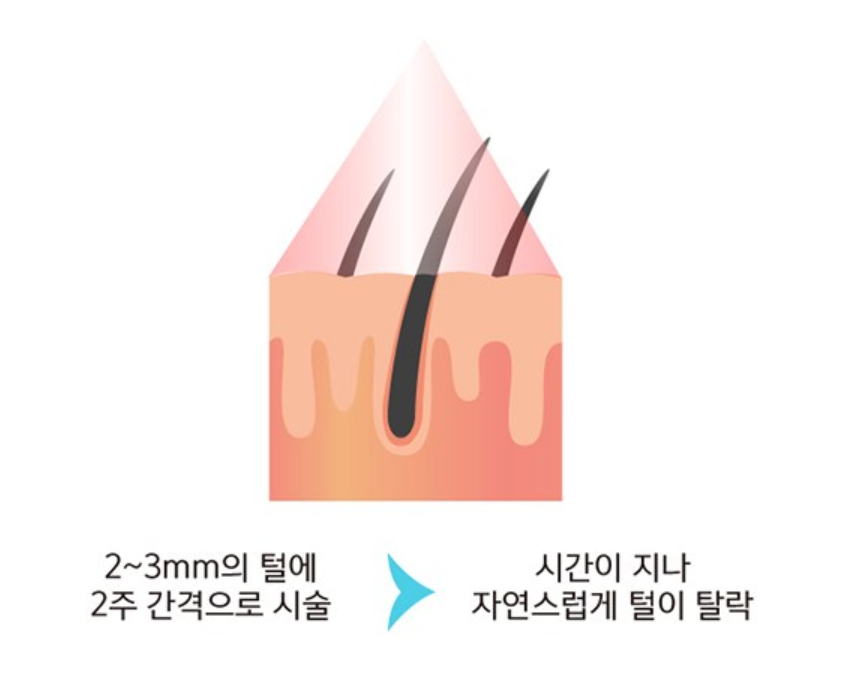 이오시카 레이저 제모기 - 이오시카 제모 의료기기의 기술