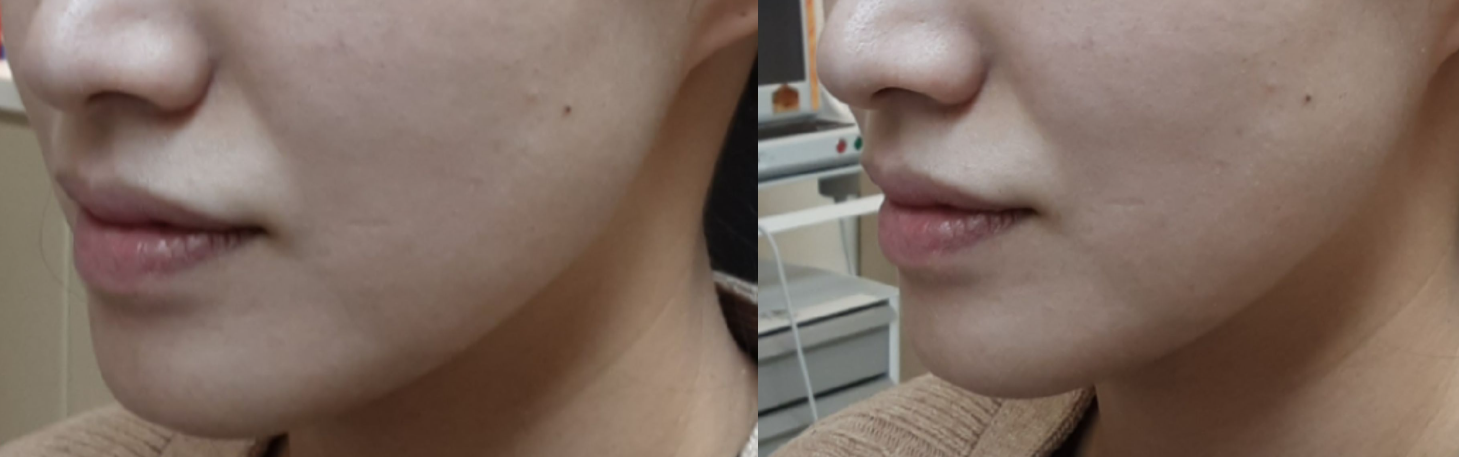  써마지 효과 있나요?